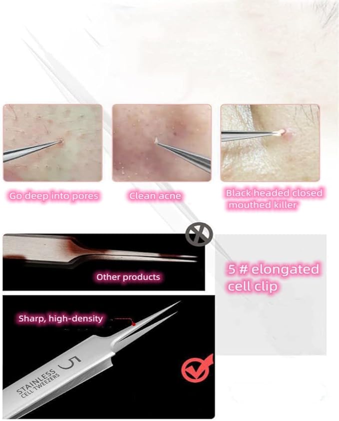 Professional Facial Blackhead Remover Tweezers,Extractor Acne Removal Kit Pimple Popper Tool, Clip for Whiteheads, Acne Clip, Ingrown Hairs Tweezers, Blackheads Remover Extractor, Stainless Steel