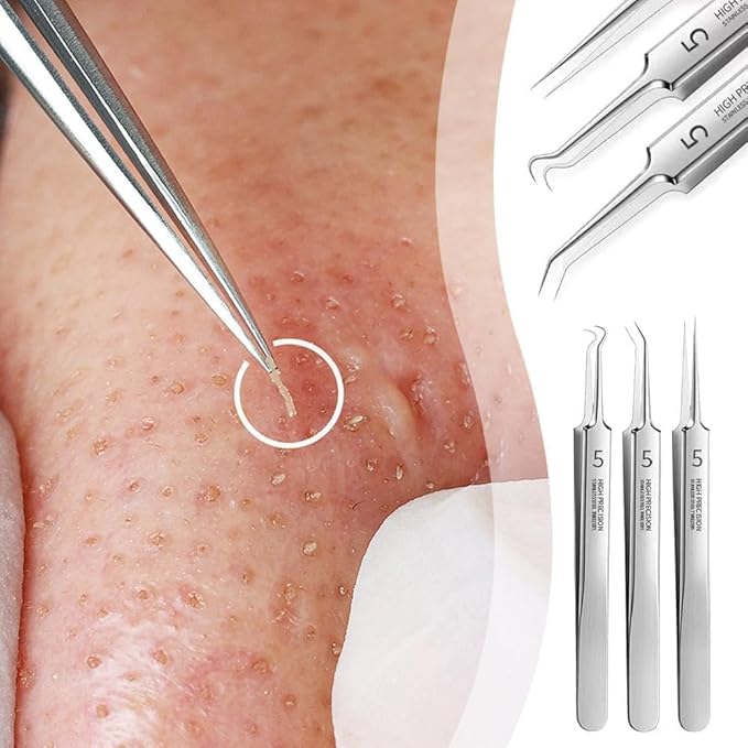 3 Pcs Silver Professional Blackhead Tweezer Professional Facial Blackhead Remover Tweezers Precision Extractor Acne Blemish and Blackhead Removal Tools l with Storage Box Skin Care Tools Accessories