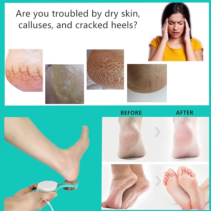 Foot File Callus Remover 5-in-1, 2 Pcs Feet Scraper Pedicure Tools with Pumice Stone, Scrubber Brush, Stainless Steel Foot Rasp and Sand Paper Debris Catcher, Multi Purpose, Cyan