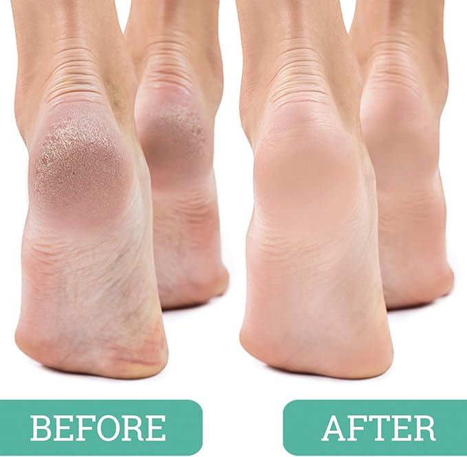 Maccibelle Salon Foot Pumice and Scrubber for Feet and Heels Callus and Dead Skins, Safely and Easily Eliminate Callus and Rough Heels (Pack of 3)