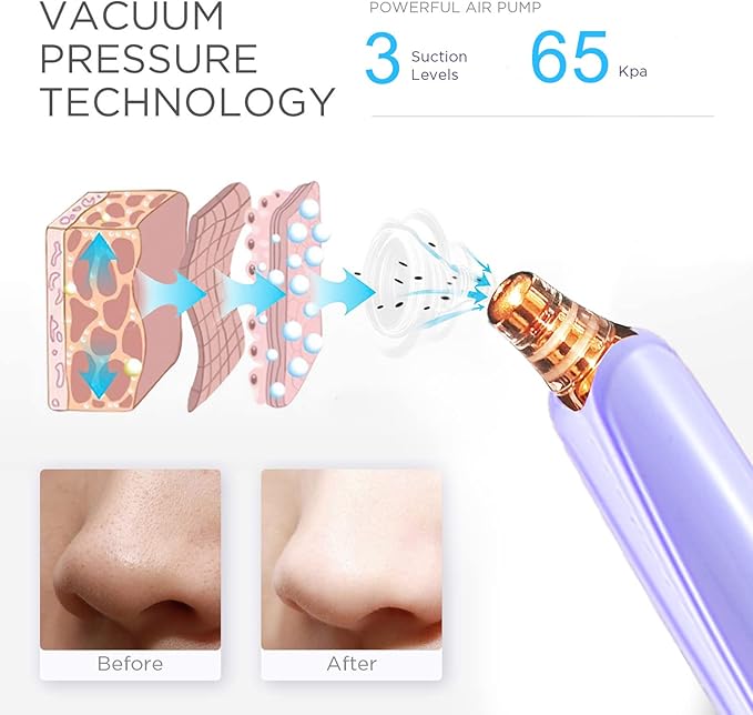 Blackhead Remover Pore Vacuum Cleaner - Upgraded Facial Pore Cleaner - Electric USB Pore Vacuum with 5 Probes - Upgraded Blackhead Suction Tool - Blackhead Remover Kit