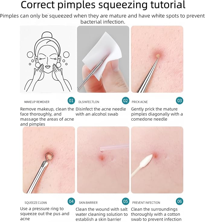 3 Pcs Blackhead Remover Comedone Extractor, Acne Removal Kit, Manual Pimple Popper Tool for Quick and Easy Removal of Pimples, Blackheads on Forehead, Facial and Nose (Needle 3 Pack)