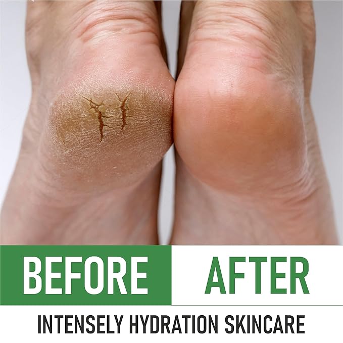 Urea 40% Foot Cream – Made in USA, Dermatologist Tested, Intensive Repair for Dry, Cracked Heels, Calluses & Rough Feet, Professional Strength Exfoliating & Moisturizing Cream - Pack of 3