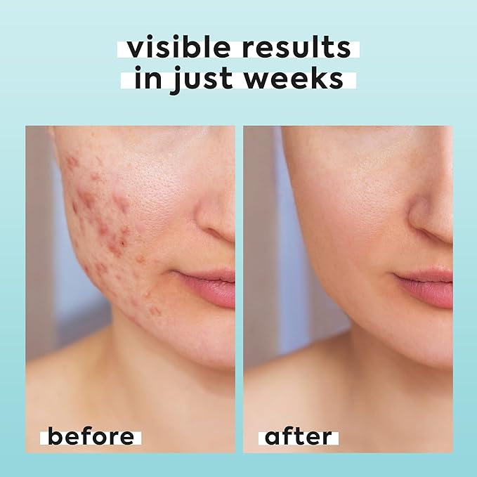 2 Pack Hypochlorous Acid Spray for Face & Body - 2 x 3.4 fl oz - Helps Reduce Redness and Breakouts - Multi-Purpose Travel Size Hypochlorous Spray - Topical Facial Skin Repair - pH-Balancing Toner
