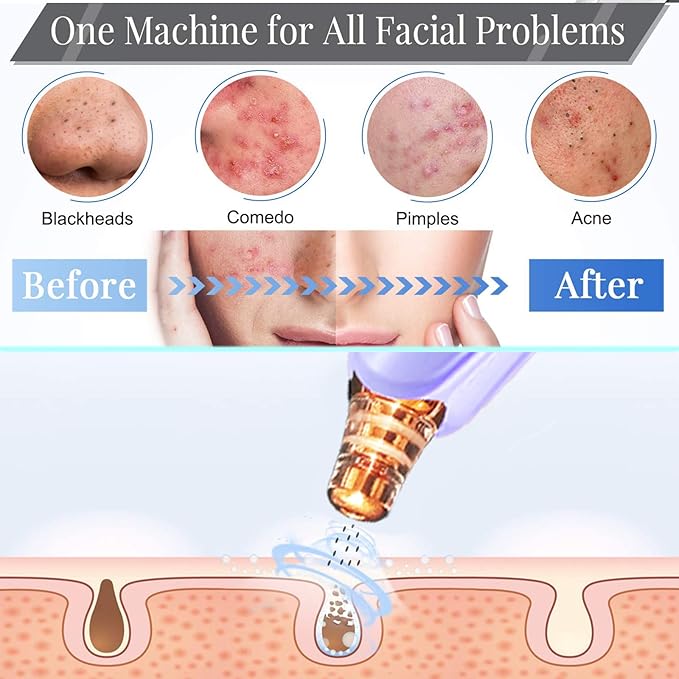 Blackhead Remover Pore Vacuum Cleaner - Upgraded Facial Pore Cleaner - Electric USB Pore Vacuum with 5 Probes - Upgraded Blackhead Suction Tool - Blackhead Remover Kit