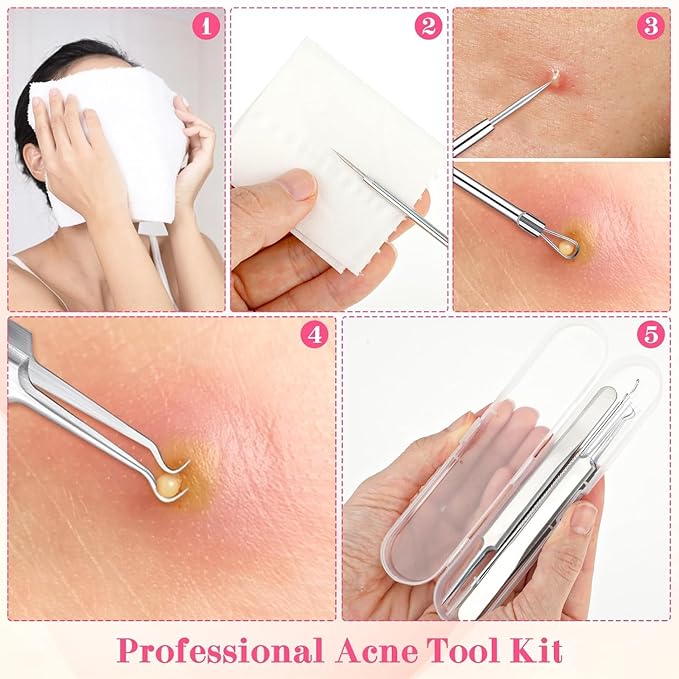 5PCS Blackhead Remover Comedone Extractor,Stainless Pimple Popper Tool，Curved Blackhead Tweezers Kit, Professional Stainless Pimple Acne Blemish Removal Tools Kit，Blackhead Extractor Tool