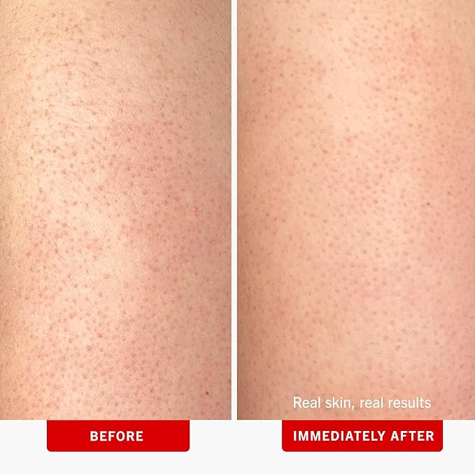 First Aid Beauty - KP Bump Eraser Body Scrub with 10% AHA, Keratosis Pilaris Skin Exfoliater with Glycolic and Lactic acids, Helps Reduce Chicken Skin Bumps, Safe for Sensitive Skin, 4 oz