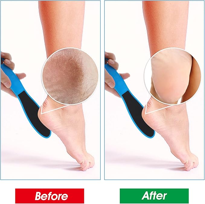 4 Pieces Double Sided Pedicure Foot File Foot Scraper, Exfoliator Remover Dead Skin Hard Skin Calluses Foot Scrubber Reusable Foot Care Pedicure Tool for Wet and Dry Cracked Feet 2 Sizes
