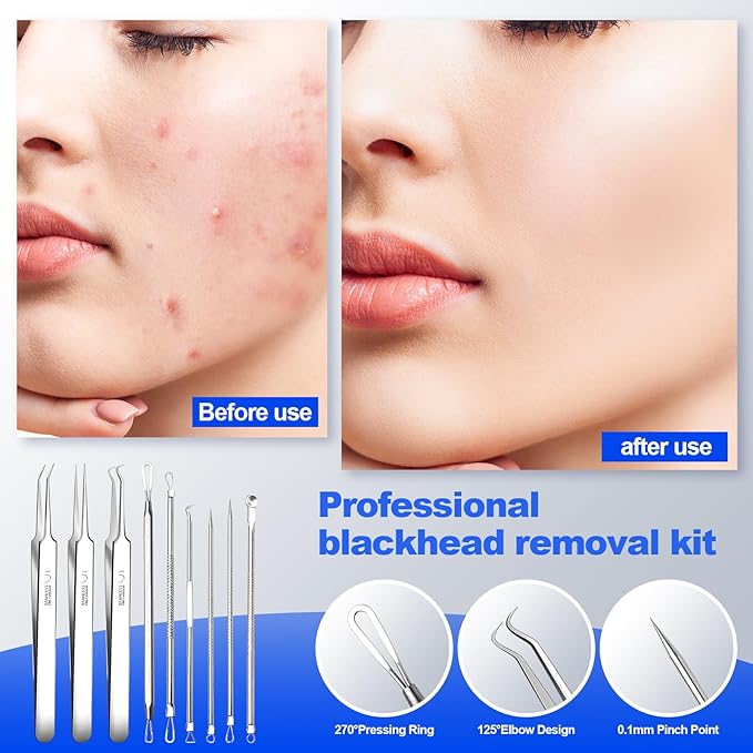 Blackhead Remover Pimple Popper Tool Kit 10PCS Professional Stainless Steel Blackhead Tweezers,Pimple Extractor for Removing Pimples, Zit on Face - Acne Removal Kit with Case Magnifier