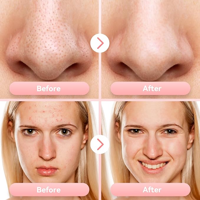 Blackhead Remover Pore Vacuum with 5 Adjustable Suction Levels Rechargeable Pore Cleaner, Electric Tools Kit