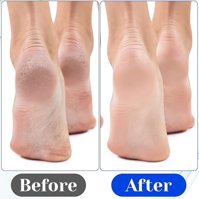 12 Pcs Foot File Callus Remover Replacement Blades Metal File Callus Remover Shaver Blades Hard Skin Remove Stainless Steel 2 Designs Big/fine Hole for Detachable Foot Scrubber