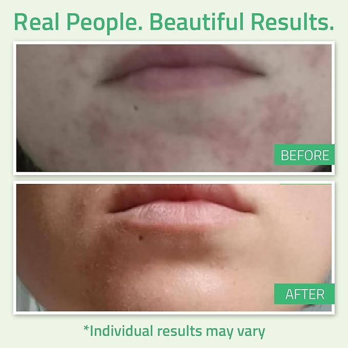 YEOUTH Glycolic Acid Peel for Face, At Home Chemical Exfoliator AHA 30% Glycolic Acid Face Peel with Retinol, Designed to Refresh and Smooth the Appearance of Skin 1oz