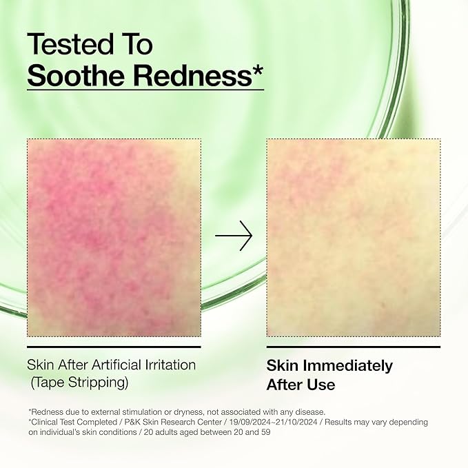 Anua Azelaic Acid 10 Hyaluron Redness Soothing Serum, Facial Serum for Blemish-Prone & Oily-Prone Skin, Lightweight & Hydrating Blemish Care, Hyaluronic Acid, Korean Skincare, 1.01 fl oz.