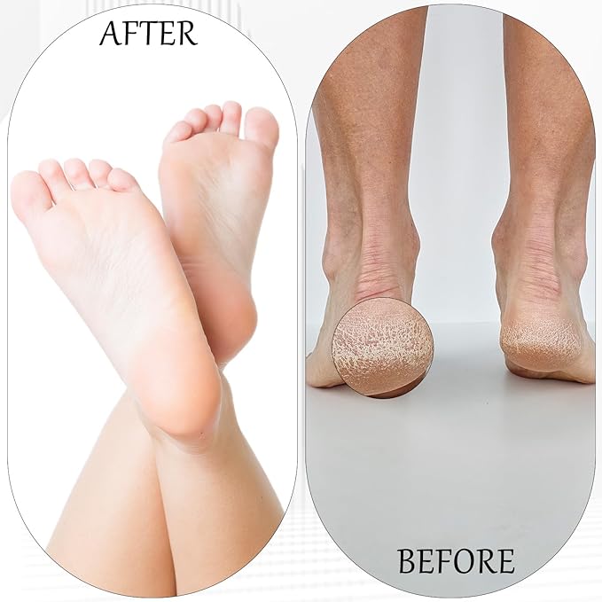 8 PCS Foot File, Callus Remover for Feet Stainless Steel Replacement Blades 2 Designs Big & Fine Hole Foot File Pedicure Tool Detachable Feet Scrubber for Rasp Corn Hard Skin Remove, Wet and Dry Use