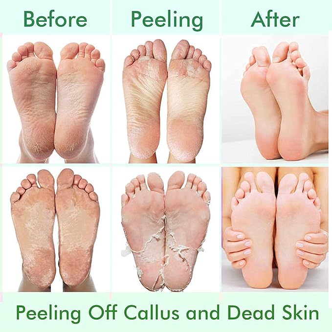 5 Pack Foot Peeling Mask,Exfoliator Peel Off Calluses Dead Skin Callus Remover,Foot Mask for Dry Cracked Feet,Foot Peel Masks for Men and Women Feet Peeling Mask for Easter Basket Stuffers Gifts