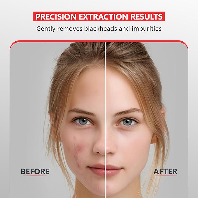 Suvorna Skinpal milia Remover Tool, Pimple Popper, Extractor for Pimple, Blackhead, Whitehead, Comedone, Acne, Zit, Blemish, Cyst, Spot, Lancet Needle for face Popping, Lancet for Facial Extraction.