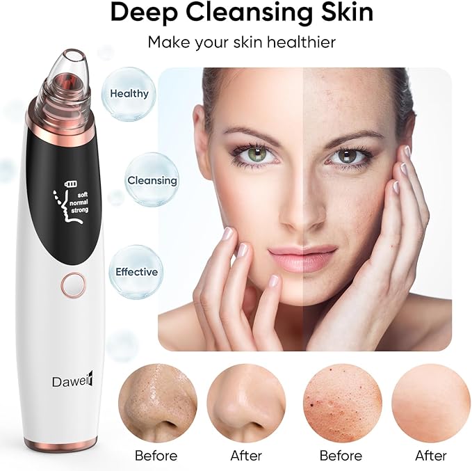 Blackhead Remover Pore Vacuum for Face & Nose – Deep Cleansing Blackhead Remover Tools with 3 Suction Levels, 5 Replaceable Tips, USB Rechargeable Pore Cleaner