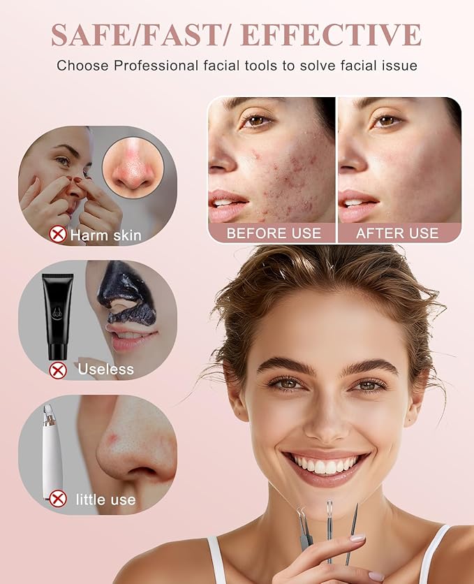 3PCS Pimple Extractor Acne Treatment Tool Professional Stainless Blackhead Comedone Removal Popper Tool for Face Nose Blackhead Extractor Tool (Black)