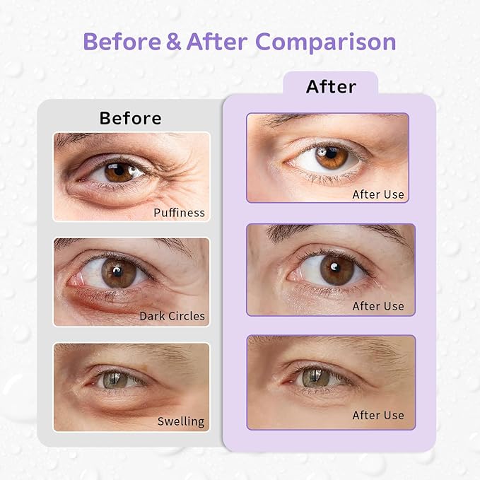 4PCS Gel Eye Ice Pack Set, Cold & Hot Compress, Reusable Cooling Gel Pads for Strain Relief, Swelling, Dark Circles, Redness, Puffy Eyes, Surgery Recovery(4 Purple flowers)