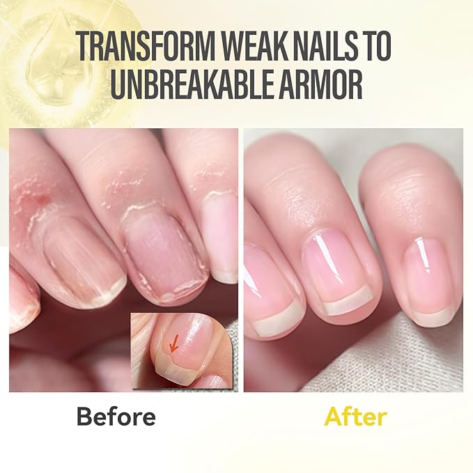 CHUCHU Nail Growth and Strengthener Oil for Cuticle - Pineapple Scent Cuticle Oil Repair Moisturizing Treatment - Natural Jojoba Vitamin B & E Nail Oil for Dry Cracked Nails