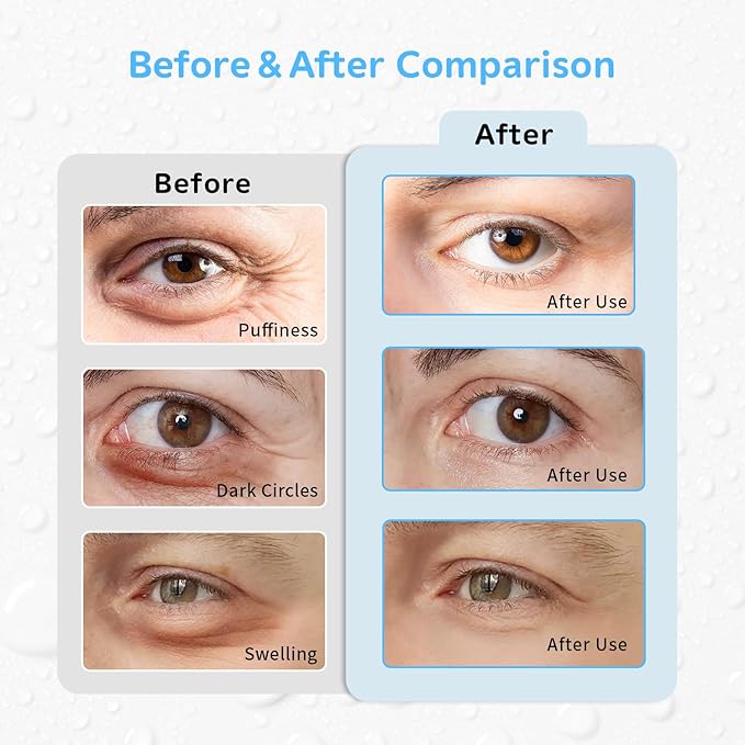 4PCS Gel Eye Ice Pack Set, Cold & Hot Compress, Reusable Cooling Gel Pads for Strain Relief, Swelling, Dark Circles, Redness, Puffy Eyes, Surgery Recovery (4 Blue flowers)
