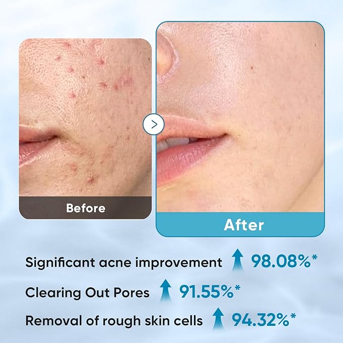 Elvira Glycolic Acid Exfoliating Facial Pads With 10% Glycolic Acid, 2% Salicylic Acid & Niacinamide - 60 Toner Pads, Daily Peel Treatment for Acne Prone Sensitive Skin