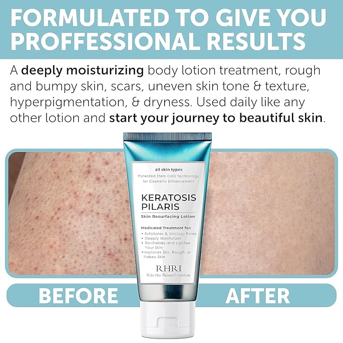 KP Bump Eraser Body Scrub with 10% AHA | Keratosis Pilaris Treatment | Bump Eraser Body Scrub | Ingrown Hair Treatment | Clears Strawberry Legs | Soothes Redness, Dryness & Flaky Skin