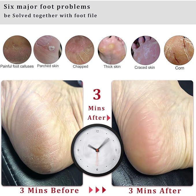 Foot File Callus Remover Foot Scrubber,Professional Pedicure Foot Rasp Removes Cracked Heels,Dead Skin,Corn,Hard Skin,Pumice Stone for Scraper File Brush Tools for Wet and Dry Feet