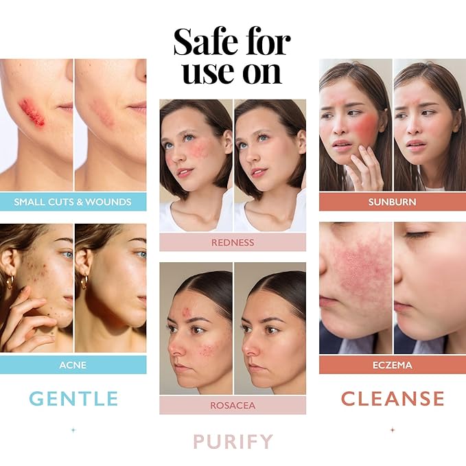 Hypochlorous Acid Spray for Face and Skin; Facial Cleanser | 8oz Face Mist Hypochlorous Acid Spray for Skin, Acne, Rash, Eczema, Wound | Antimicrobial Facial Cleanser Acne Sprays; Smart Skincare