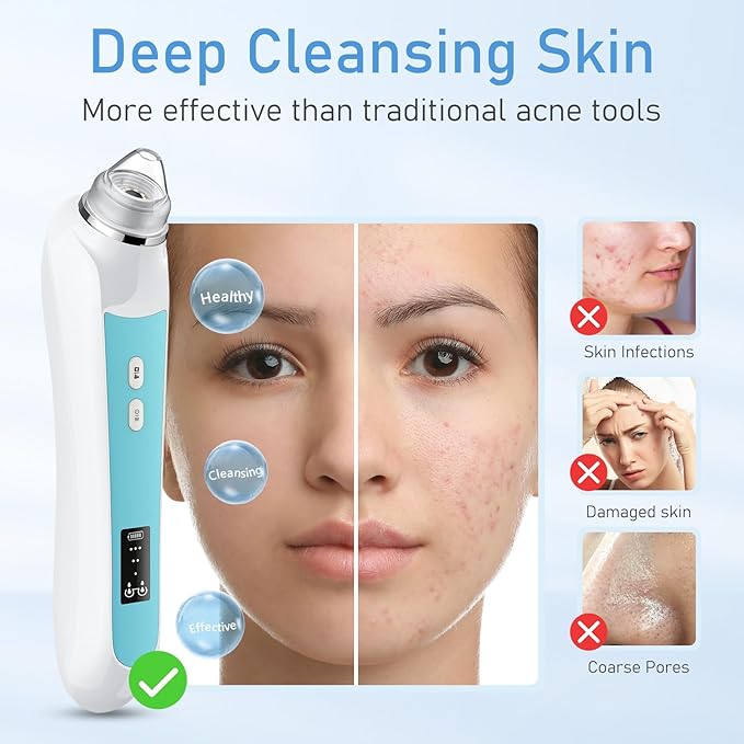 Blackhead Remover Vacuum, USB Interface Type Pore Vacuum, Black Head Extractions Tool with Camera for Men and Women Pore Cleaner, 3 Adjustment Modes & 6 Suction Heads(Blue)