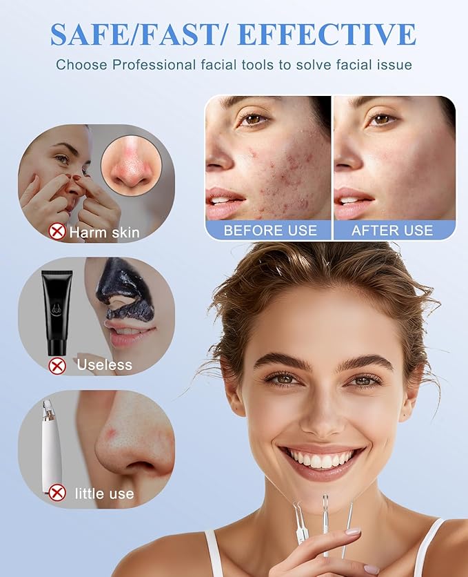 3PCS Pimple Extractor Acne Treatment Tool Professional Stainless Blackhead Comedone Removal Popper Tool for Face Nose Blackhead Extractor Tool (Silver)