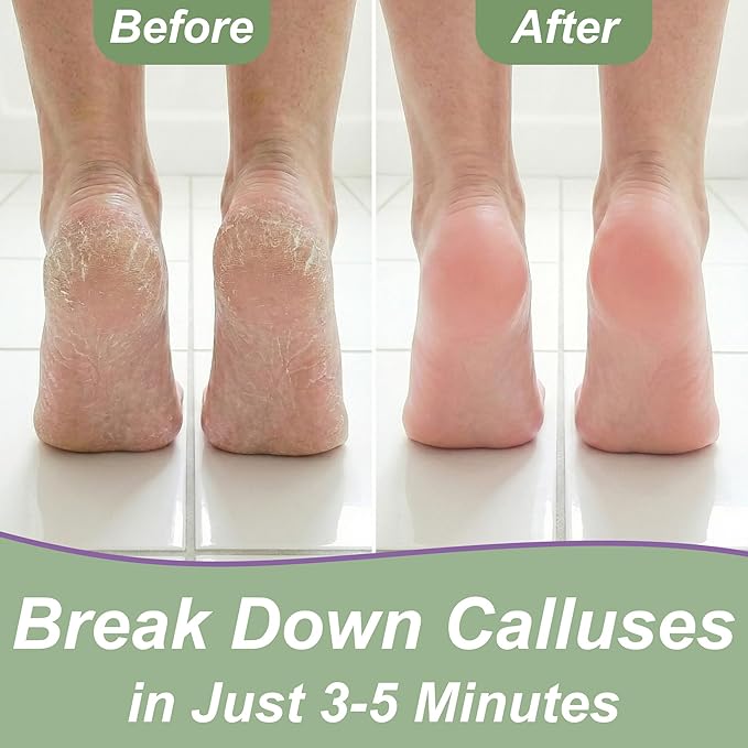 Callus Remover for Feet (Extra Strength 8 oz) Foot Callus Remover Gel, Spa Foot Care, Pedicure Tools for Feet Scrubber