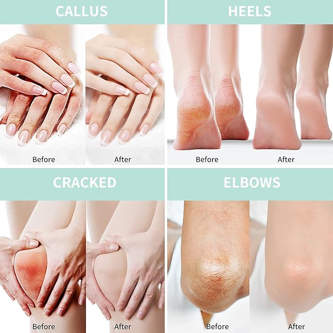Grocerism 2 Packs Urea Cream 40% Plus 2% Salicylic Acid 5.30 oz || Foot Cream Maximum Strength with Hyaluronic Acid, Tea Tree, and Aloe Vera for Deep Moisturizes, Callus Remover and Soften