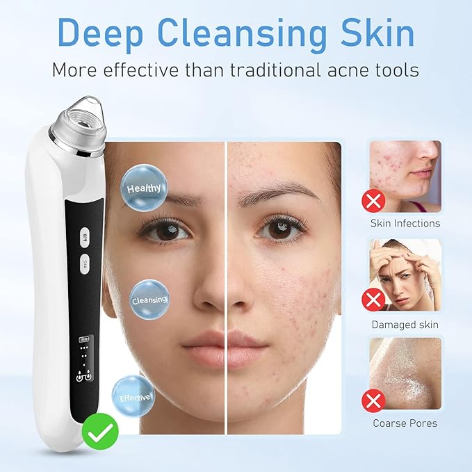 Blackhead Remover Vacuum, USB Interface Type Pore Vacuum, Black Head Extractions Tool with Camera for Men and Women Pore Cleaner, 3 Adjustment Modes & 6 Suction Heads(Black)