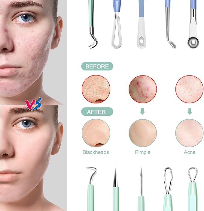Blackhead Remover Tools MENOLY 10Pcs Pimple Popper Tool Kit, Blackhead Remover Extractor Tools, Pimple Comedone Extractor Acne Kit for Blackhead,Blemish,Zit Whitehead with Leather Bag