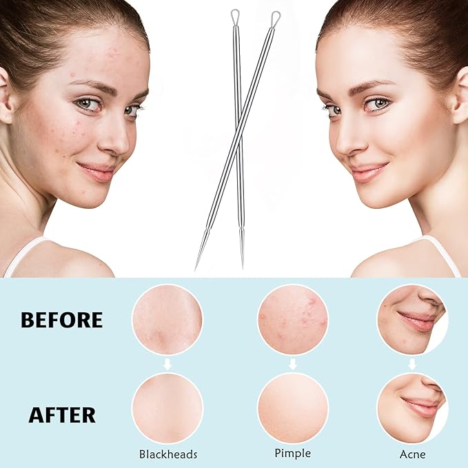 Titanium Lancet Needle Pimple Popper Tool Facial Milia Remover Blackhead Blemish Remover Blackhead Whitehead Extractor Professional Lancet Zit Blemish Comedone Removal Tool 2 Pieces with Box