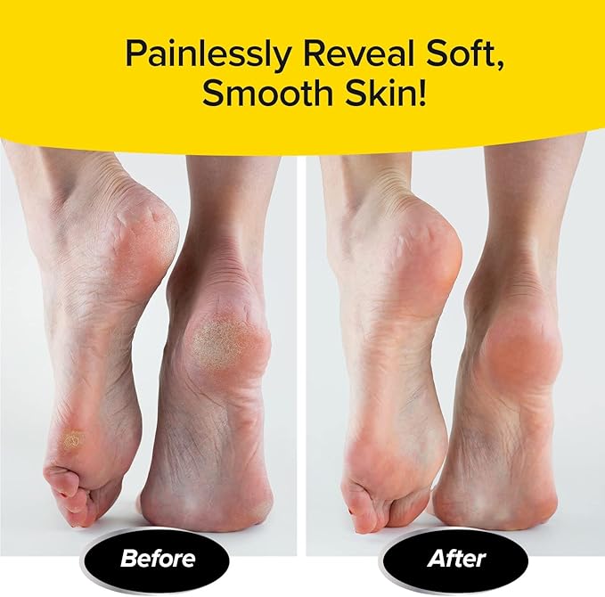 PedEgg Foot File – Traps Shavings Inside for Mess-Free Use – Painless Callus Remover with Ergonomic Handle for Tough, Dry Skin & Smooth, Soft Feet
