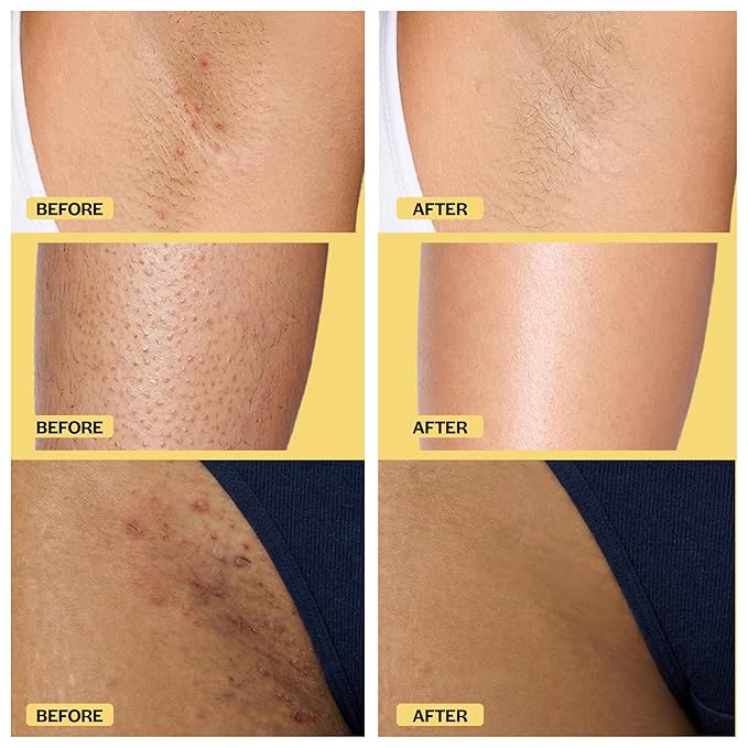 Base Laboratories Ingrown Hair - KP Bump Exfoliating Body Scrub - with AHA+BHA - Keratosis Pilaris Treatment - Daily Skin Exfoliant - Helps Reduce Strawberry Skin & Razor Bumps - Men & Women 3oz