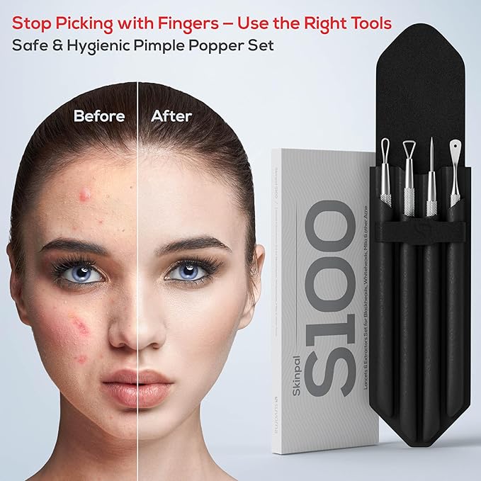 Suvorna Pimple Popper Tool Kit | Milia Remover | Lancets for Facial Extraction | White head Extractor Tool for Face | Comedone Extractor | Blackhead Remover tool | Acne Needle Tool & Cyst Removal Tool
