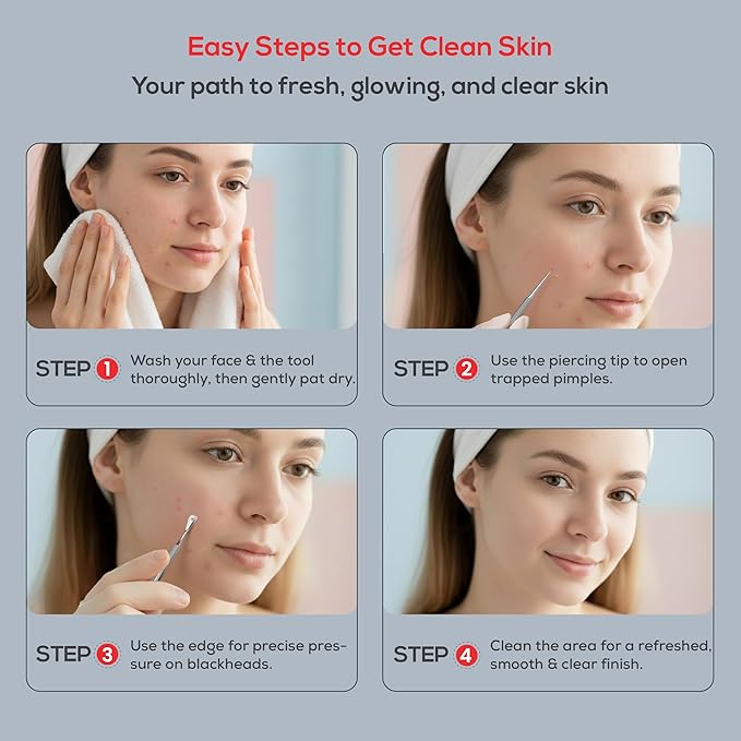 Suvorna Skinpal Milia Remover, Milia Extractor, Acne Needle, Cyst Removal, Blackhead and Whitehead Removal, Pimple Popper Tool, Pimple Extractor, Blemish Remover Tool and Comedone Extractor.