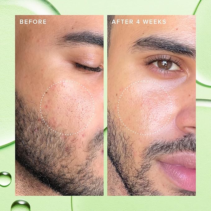 Farmacy 2% Salicylic Acid Toner for Face - Deep Sweep BHA Liquid Exfoliant + Pore Cleaner - Controls Oil, Gently Exfoliates + Refines Pores - Skin Care for Combo, Oily + Blemish-Prone Skin - (10ml)