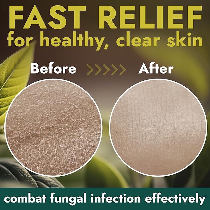 Antifungal Body Wash with Tea Tree Oil | Antifungal Soap Treats Ringworm, Back Acne, Eczema & Jock Itch | Antifungal Body Soap For Men And Women (16.9 oz)