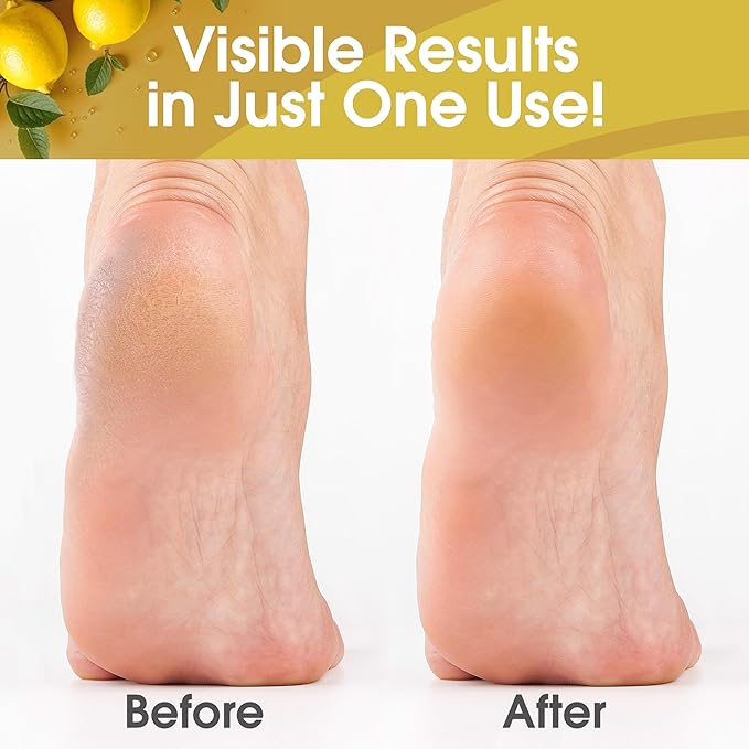 DeEnti Callus Remover for Feet, Extra Strength Foot Callus Remover Gel, 16oz Salon Grade Home Pedicure Supplies for Dry Skin, Cracked Heel, Professional Strength Foot Care, Lemon