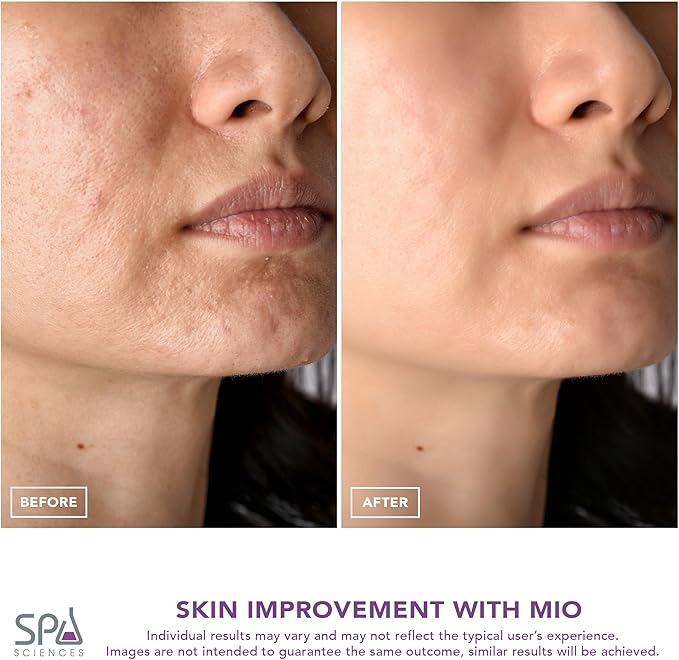 Spa Sciences MIO Diamond Microdermabrasion Blackhead Remover, Pore Suction Tool–Rechargeable-Dermatologist Recommended Skin Resurfacing System for Anti-Aging-Exfoliator for Acne Scars/Wrinkles (Mint)